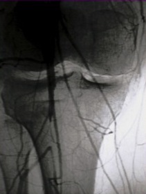 Angiogram Popliteal Artery Injury